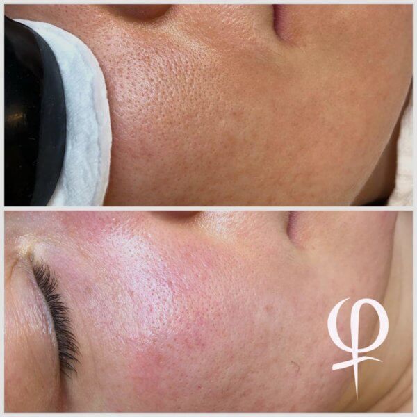 Hydrafacial Behandlung Sibylle Maas Kosmetikstudio Königstein